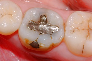 Vecchia otturazione in amalgama infiltrata da carie. Sostituzione con otturazioni estetiche in composito.