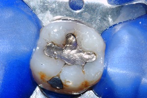 Dente isolato con diga dentale blu. Sostituzione con otturazioni estetiche in composito-