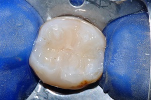 Nuova otturazione in composito del colore naturale del dente. Sostituzione con otturazioni estetiche in composito.